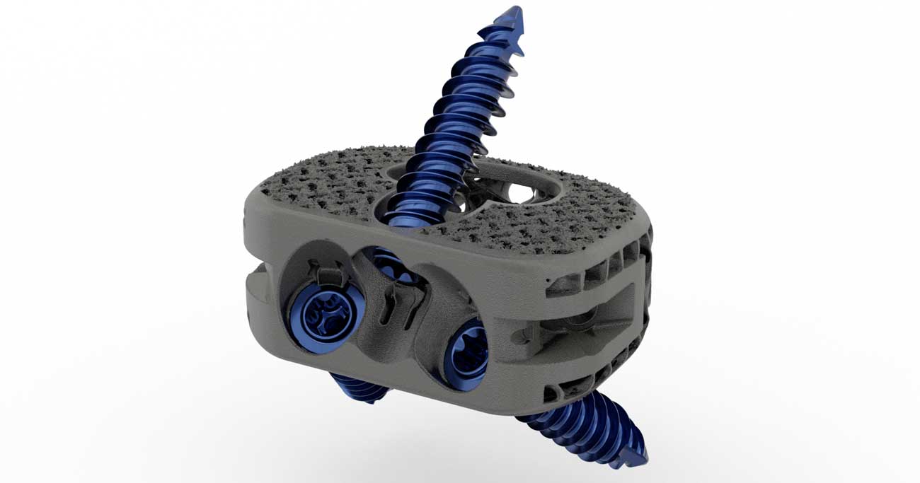 Orthofix 推出3D打印前腰椎中间体