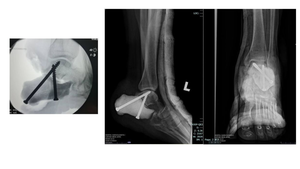 马来西亚医院利用3D打印模具成功进行了该国首次足跟骨置换手术