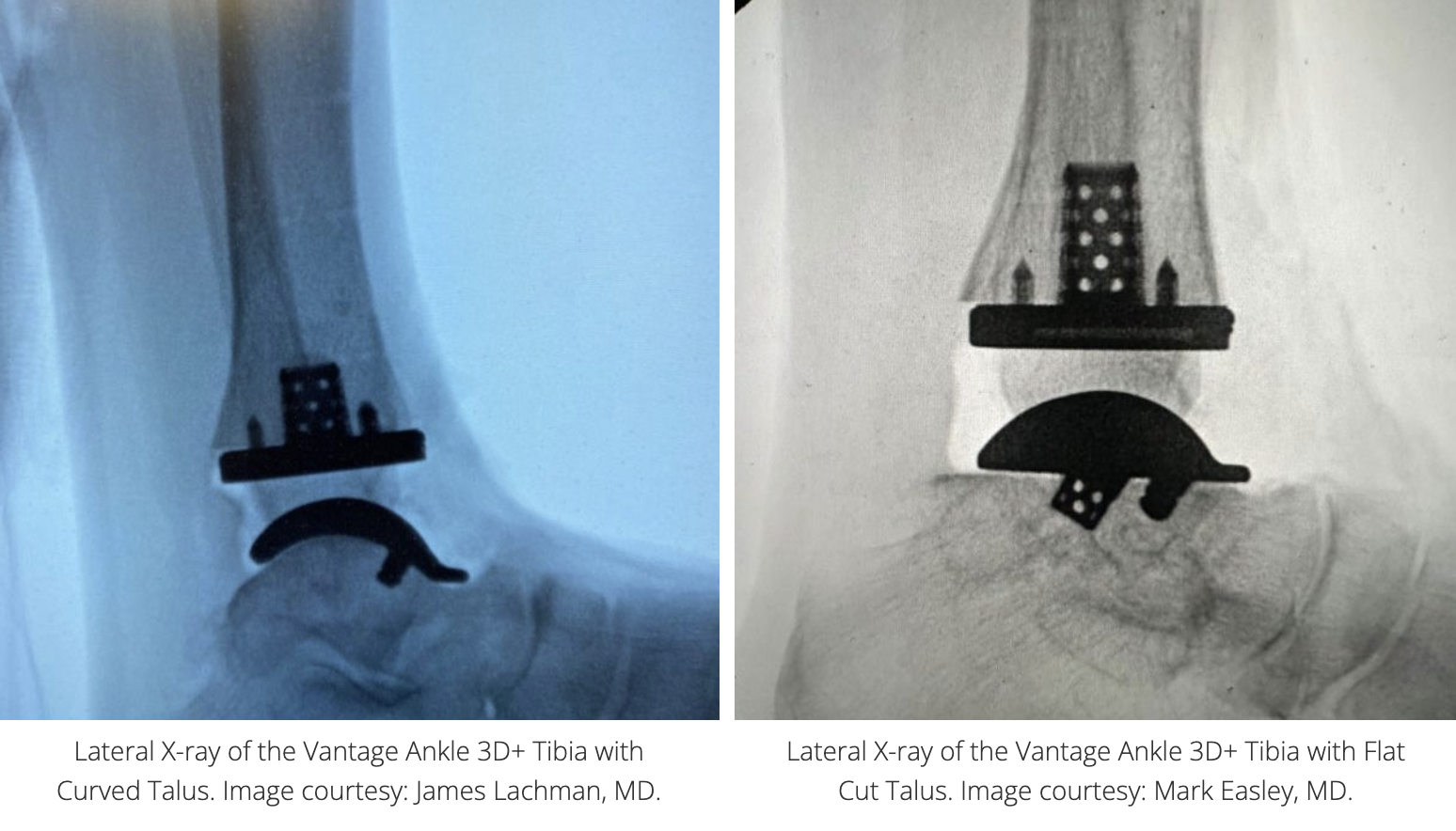 Exactech首次利用3D打印胫骨植入物进行踝关节置换手术
