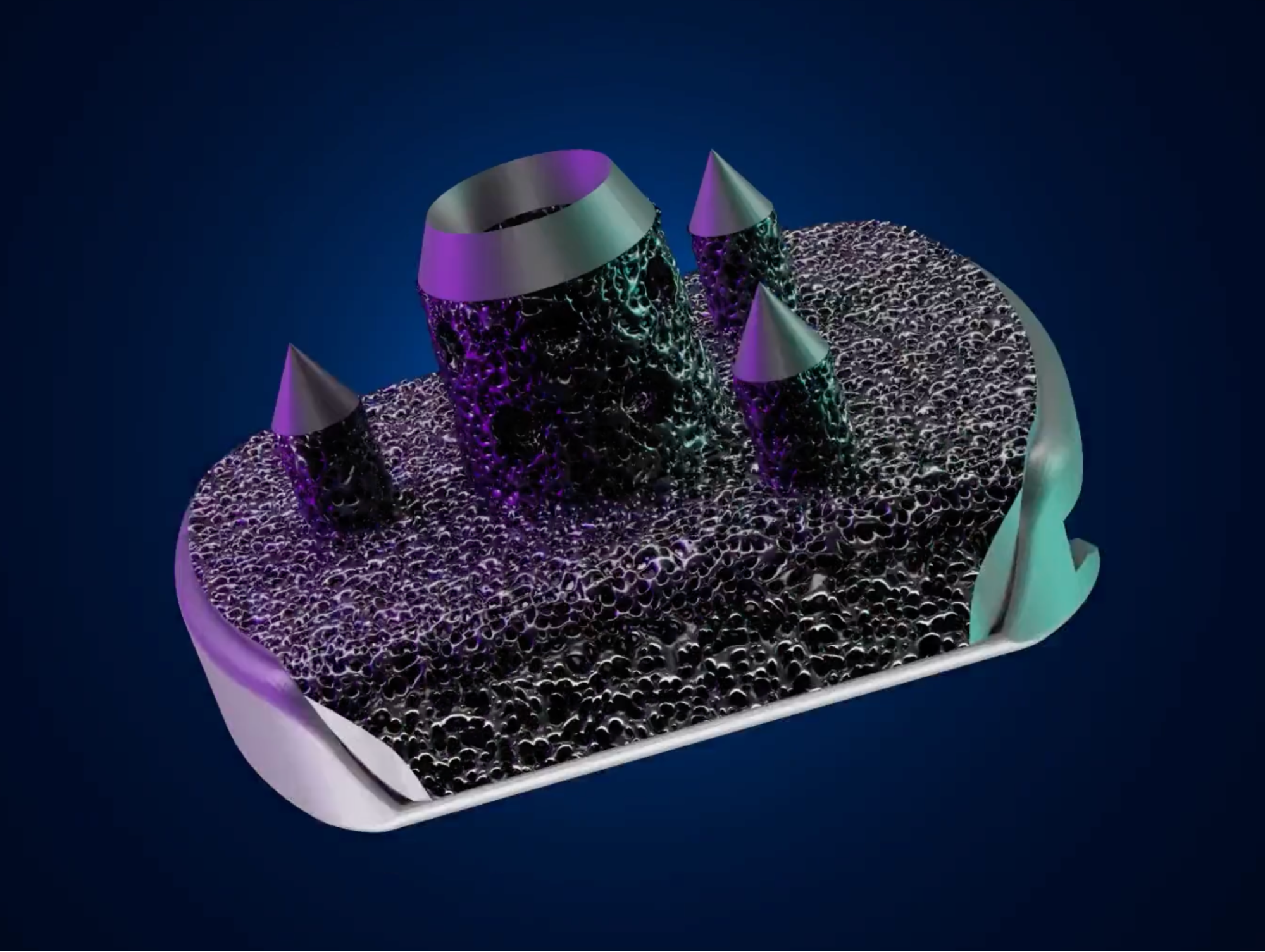 Exactech首次利用3D打印胫骨植入物进行踝关节置换手术