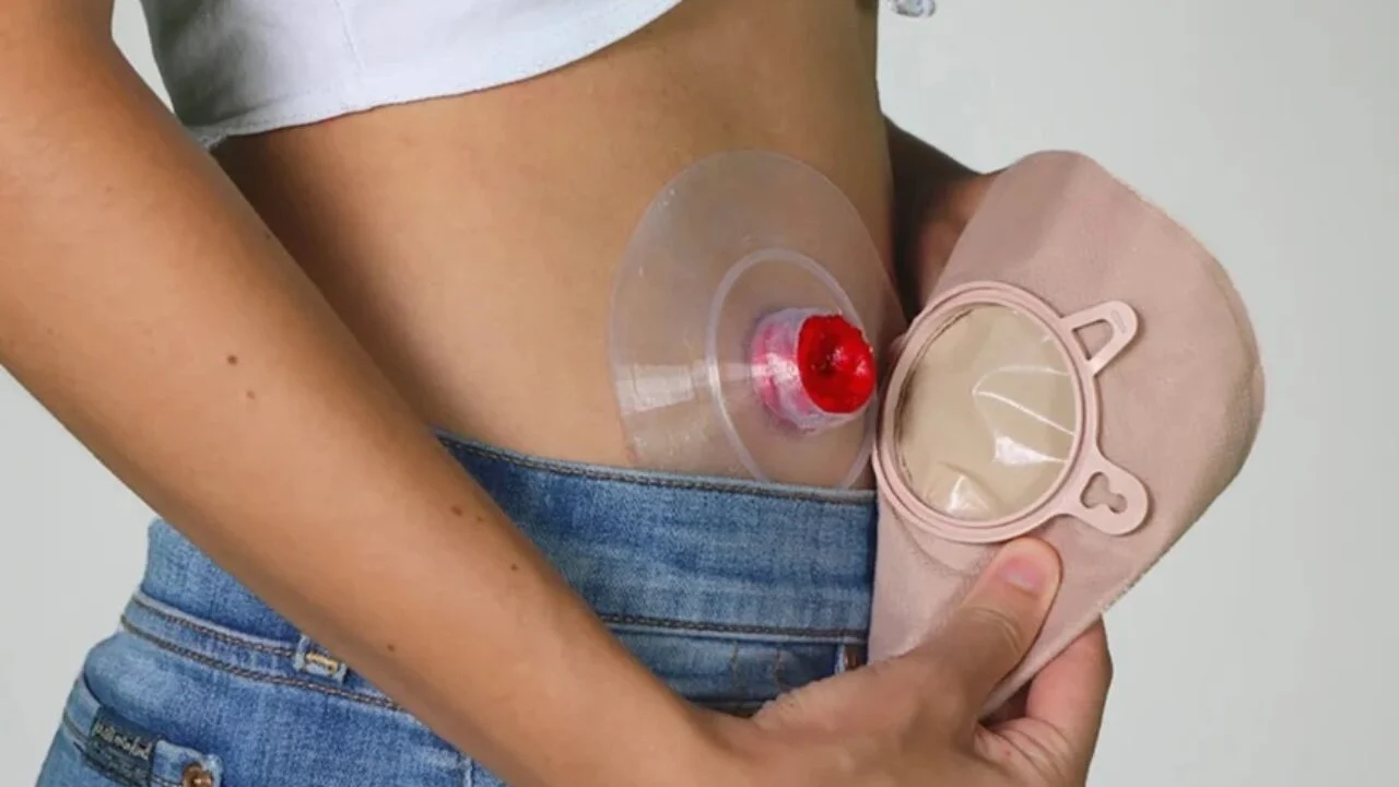 3D打印智能造口袋增强造口护理和患者舒适度